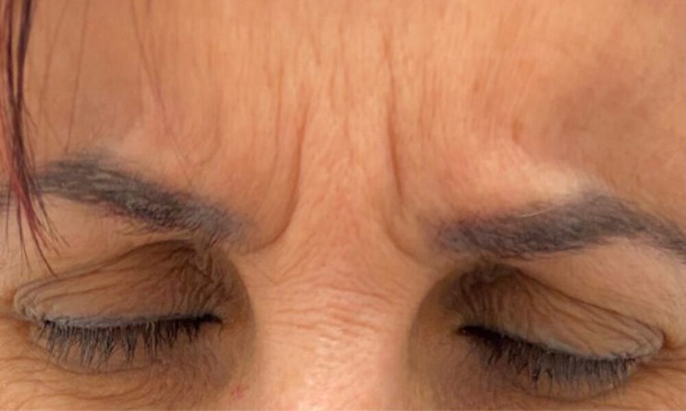 Anti Wrinkle Injections Adelaide Anti Aging Treatments Bellafache